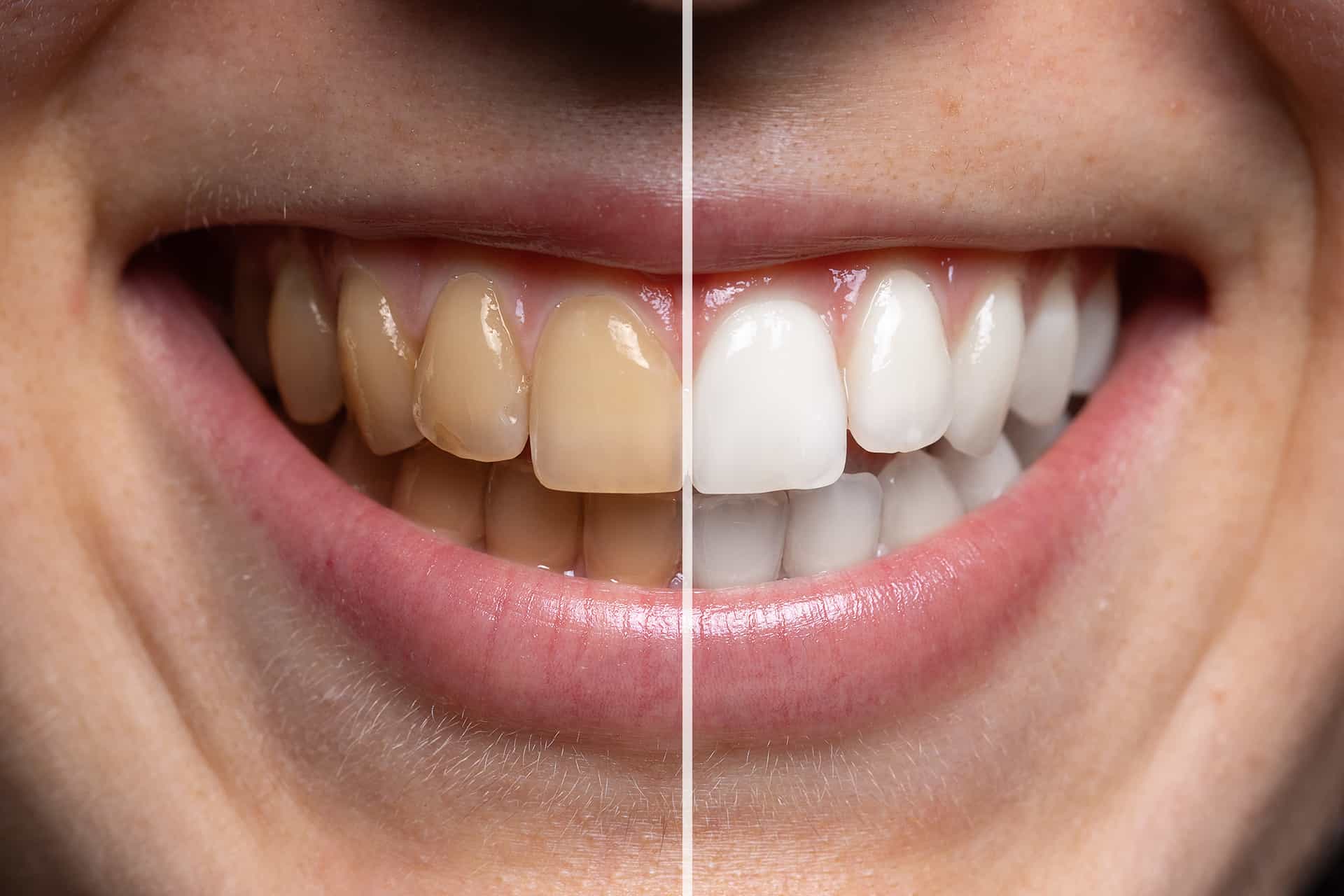 Before & After a Dental Procedure | Angstadt Dental Lancaster